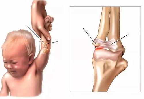 胳膊脱臼图片,图片解析与康复指导